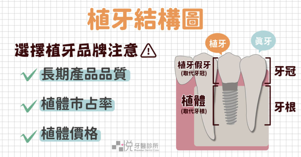 植牙假牙取代真牙牙冠，植體取代牙根。
植牙品牌考慮面向：長期產品品質、植體市占率、植體價格。