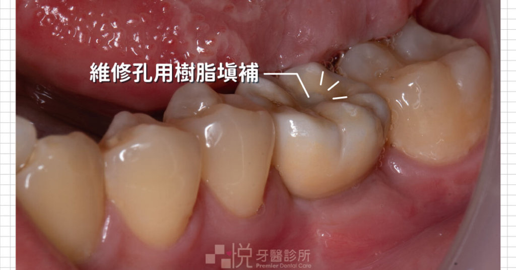 植牙維修孔會使用樹脂材料填補，後牙植牙較不容易發現色差。