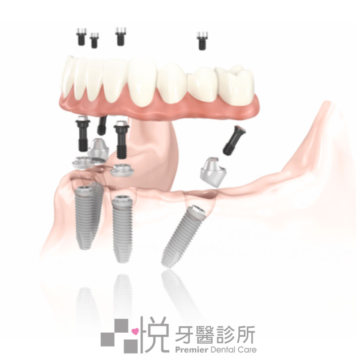 All-on-4 圖片來源：諾保科提供