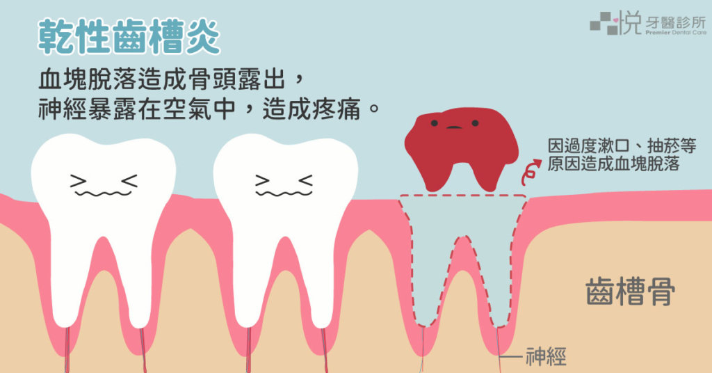 乾性齒槽炎並不是感染，而是拔牙後血塊離開傷口造成神經遭受刺激而疼痛。