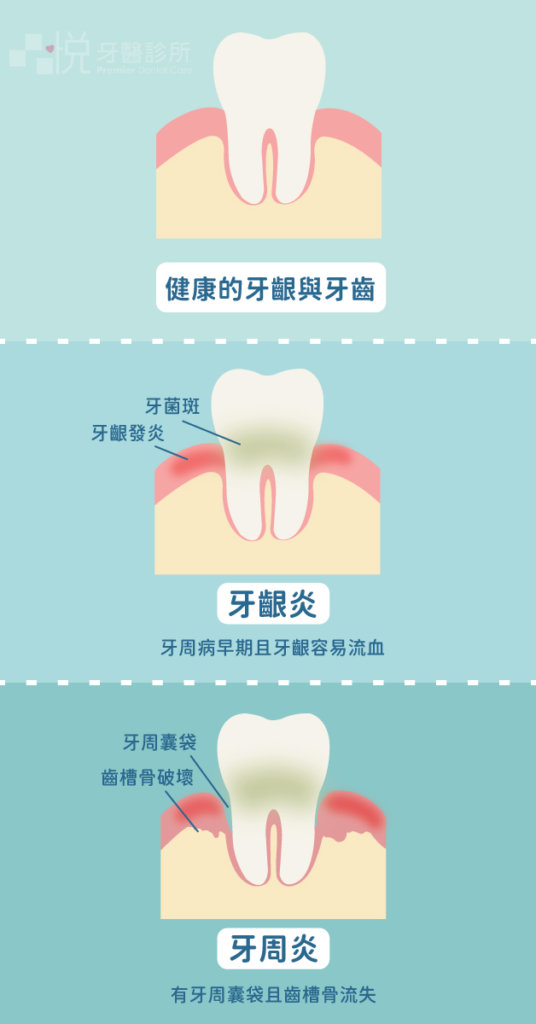 牙周病是一個進行式的疾病。起初牙齦發炎開始（牙齦炎），發炎繼續惡化導致支撐牙根周圍的齒槽骨開始侵蝕的話，我們稱之為慢性牙周炎。