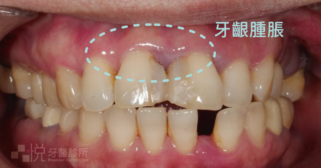 牙周病的症狀如牙齦腫脹，有時一般民眾不太能發現，建議養成定期至牙科診所檢查。