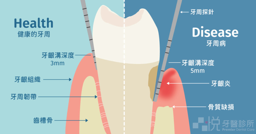 不健康的牙周會有：牙齦溝深度超過5mm、牙齦炎、齒槽骨缺損等表現