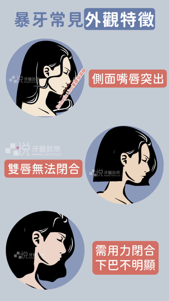 暴牙的常見特徵:
1.側臉輪廓上下嘴唇突出於美觀線 ( E-line：從鼻尖到下巴最突點的連線 ) 之外。
2.雙唇無法自然閉合。
3.上下唇要完全閉合必須用力，此動作將導致下嘴唇下方的肌肉出現皺折，下巴輪廓不明顯。