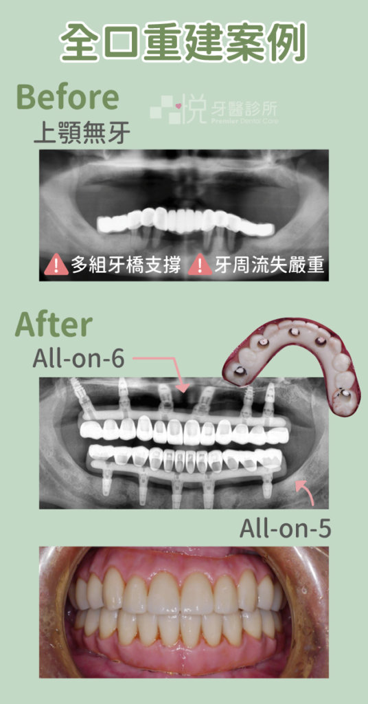 多顆缺牙常需合併多種治療方式，若是缺牙狀況嚴重也可評估使用 All-on-4 全口重建方式