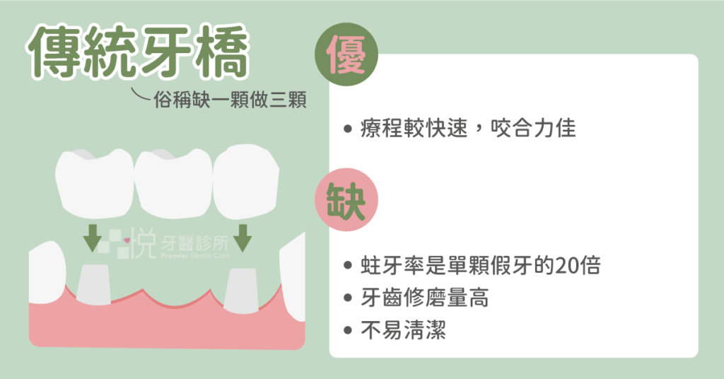 傳統牙橋適合不想手術又咬合力大的患者，但是非常容易蛀牙且左右兩邊牙齒需要磨掉非常大一部分。