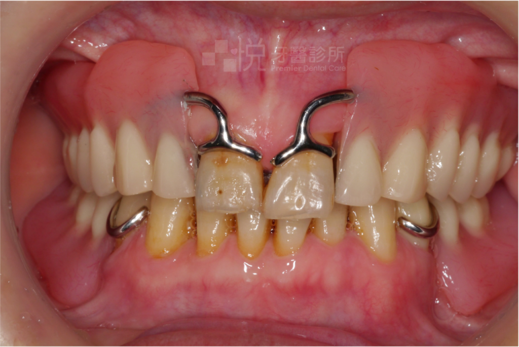 活動假牙不好看