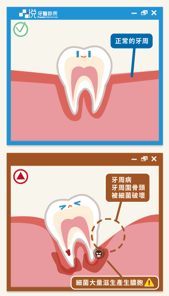 牙周病因為牙周骨頭被細菌破壞而產生膿包
