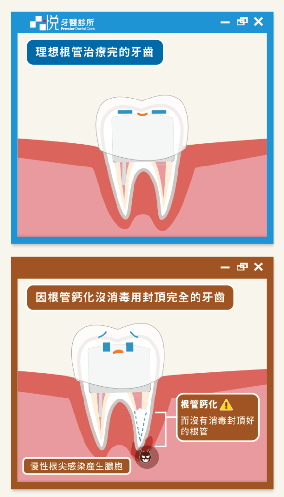 根管治療因為鈣化而無消毒完全，容易因為慢性根尖感染產生膿包