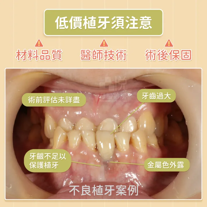 此他院案例未做好詳盡計畫的植牙：包含未事先確認空間大小，導致牙齒太大。未確認好足夠的骨頭及牙肉位置，導致牙齦高度、澎度不對，金屬色外露，且沒有足夠的角化牙齦保護植牙。
案例提供：饒庭伃醫師 品悅牙醫