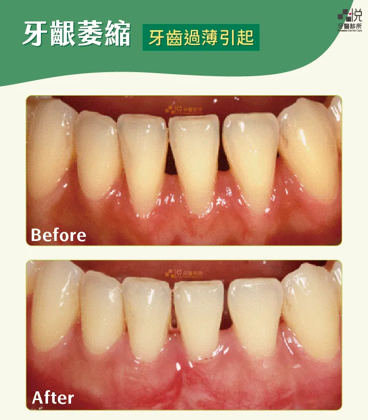 牙齦萎縮案例3｜牙肉過薄引起
案例分享：張真豪醫師 品悅牙醫