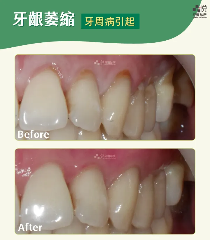 牙齦萎縮案例4｜牙周病引起
案例分享：張真豪醫師 品悅牙醫