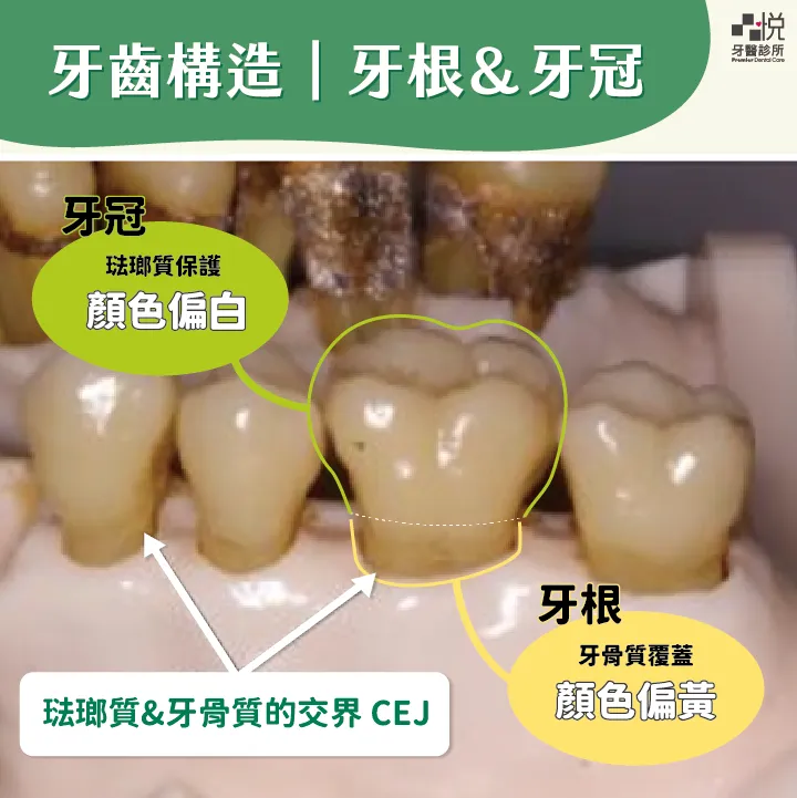 因此「牙齦萎縮」可以定義為，牙齦邊緣比琺瑯質及牙骨質的交界（Cemento-Enamel Junction, CEJ）還要下方，導致牙根表面暴露於口腔環境中。