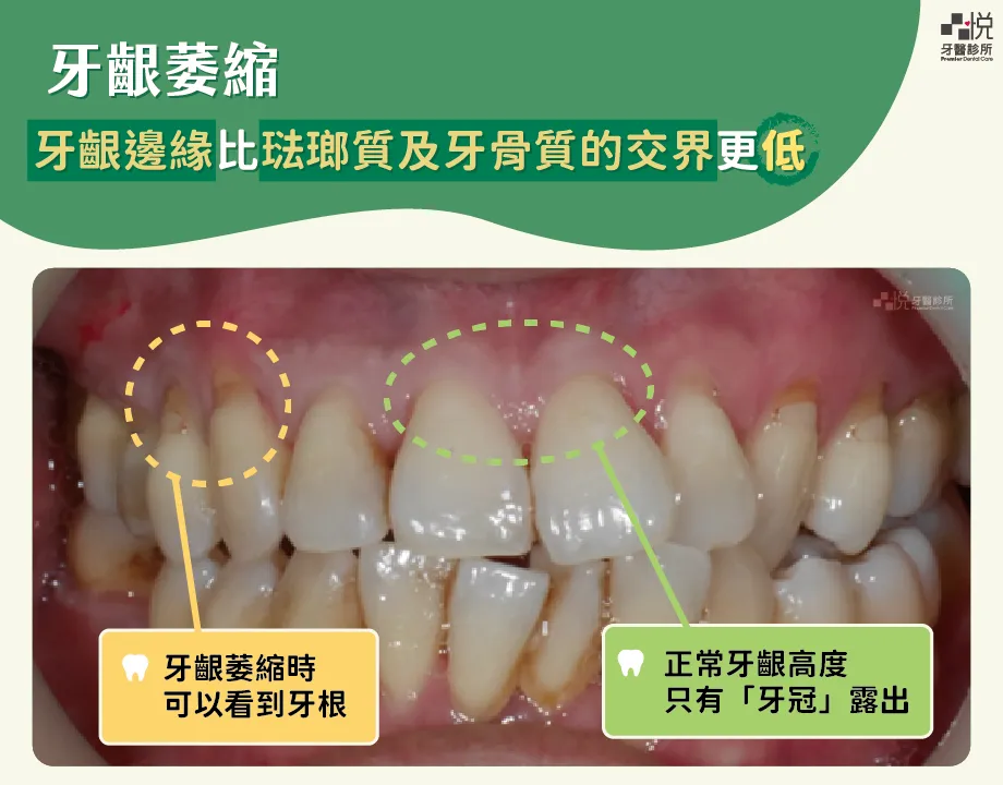 「牙齦萎縮」就是牙齦邊緣比琺瑯質及牙骨質的交界還要低，導致牙根表面暴露於口腔環境中。
案例分享：張真豪醫師 品悅牙醫