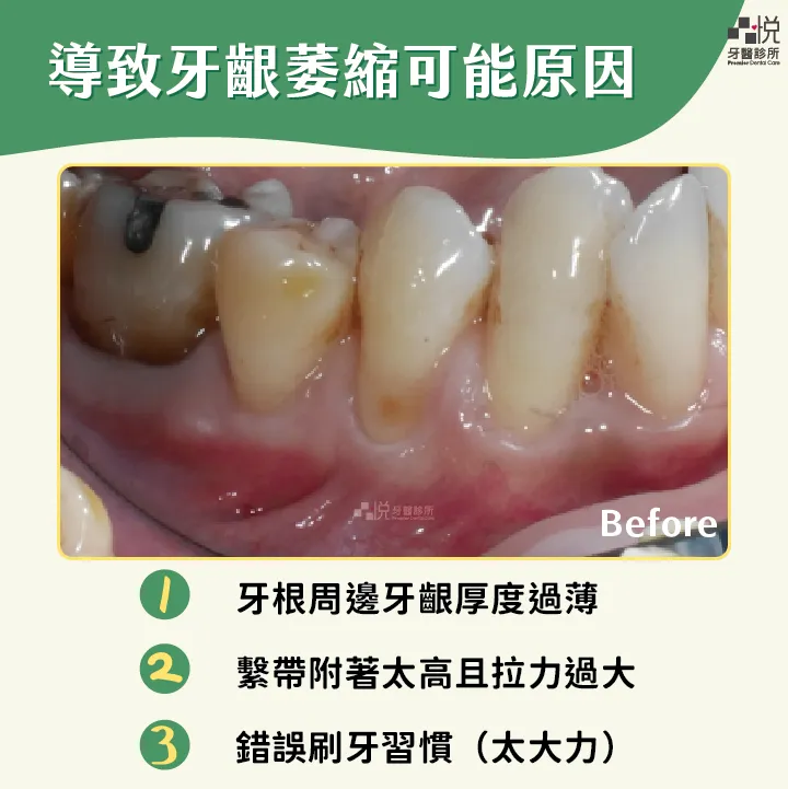 導致牙齦萎縮的可能原因
案例分享：張真豪醫師 品悅牙醫