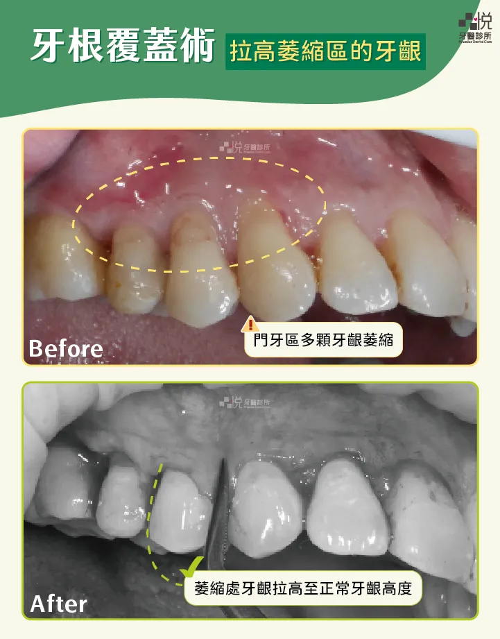 案例分享：張真豪醫師 品悅牙醫
拉高萎縮區牙齦處的牙齦｜牙根覆蓋術