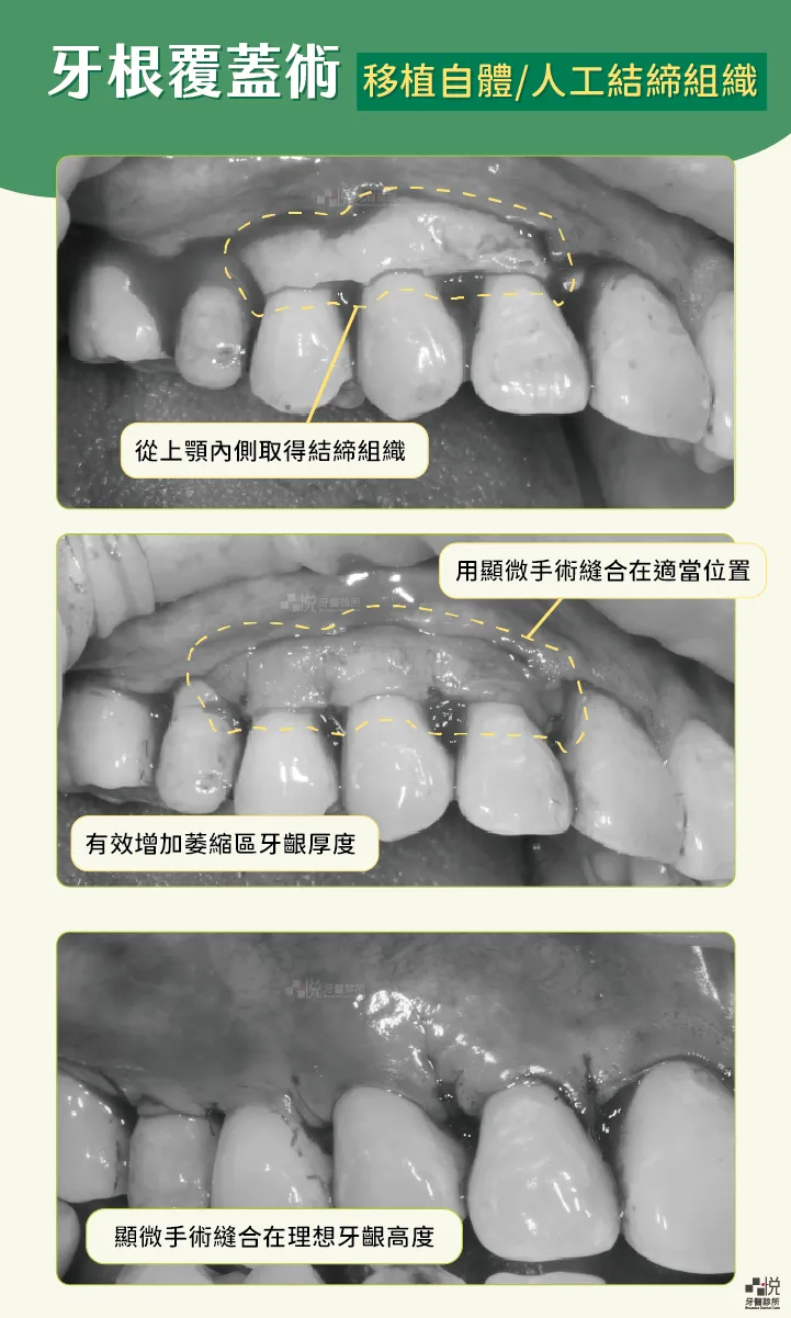 移植自體或人工結締組織，使萎縮區牙肉變厚｜牙根覆蓋術
案例分享：張真豪醫師 品悅牙醫