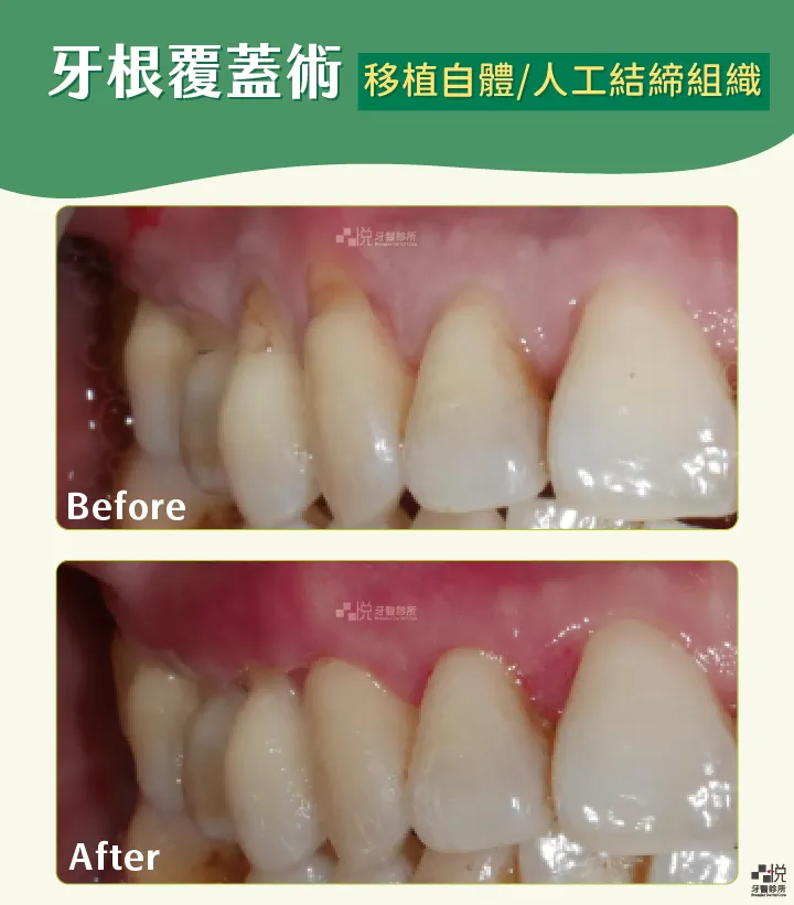 案例分享：張真豪醫師 品悅牙醫
牙根覆蓋術