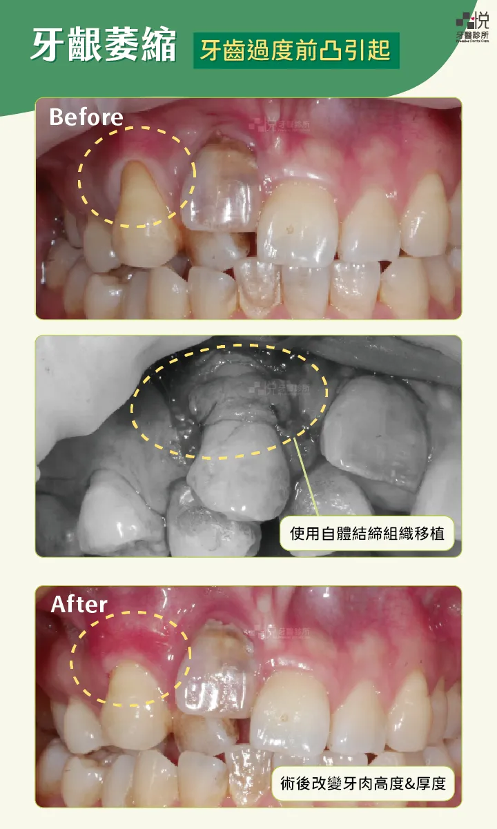 牙齦萎縮案例2｜牙齒過度前突
案例分享：張真豪醫師 品悅牙醫