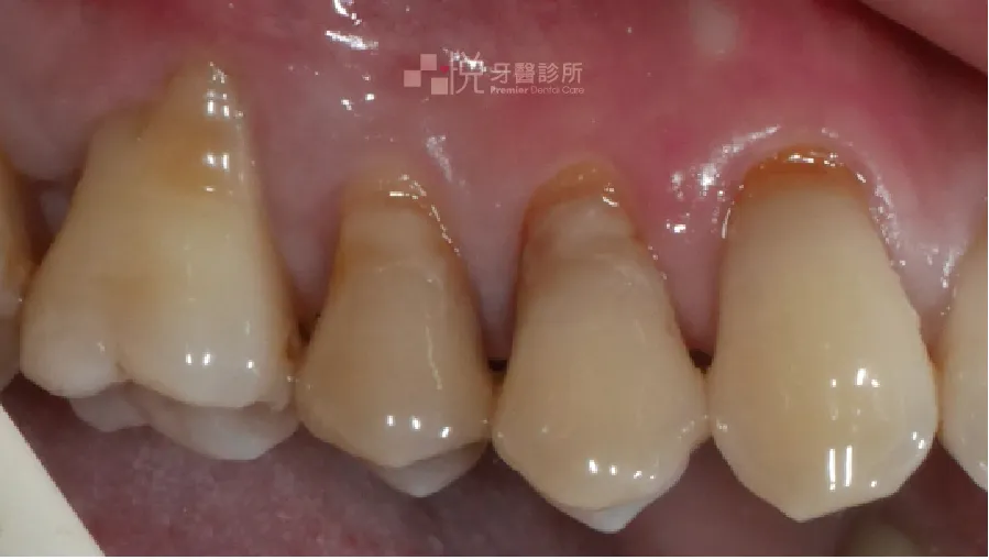 牙齒冷熱敏感

牙根表面本身並未有琺瑯質包覆，因此當有牙齦萎縮時，容易會有敏感性牙齒問題。
案例分享：張真豪醫師 品悅牙醫