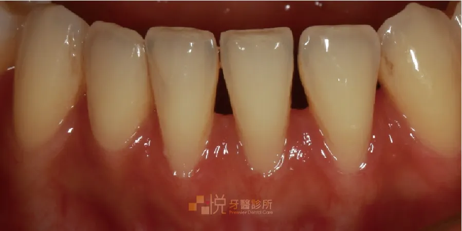 如圖牙縫比較大的情況，手術後覆蓋率會較無法預測
案例分享：張真豪醫師 品悅牙醫
