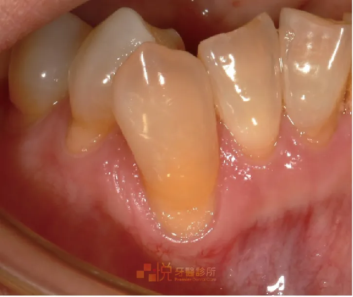 牙根表面有凹陷｜因牙根標面的硬度比琺瑯質軟，當患者有牙根裸露並使用硬毛牙刷或清潔力道過度時，容易磨耗到牙根表面，時間久了容易會有牙刷磨出來的痕跡。
案例分享：張真豪醫師 品悅牙醫
