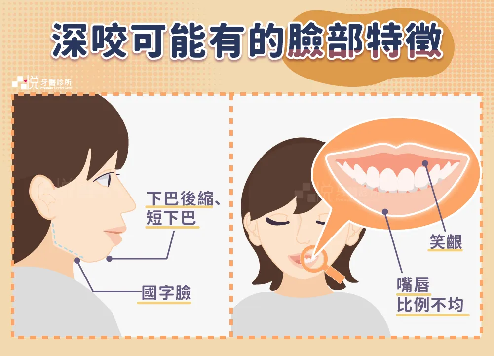 深咬會長什麼樣子？臉型有什麼特徵？
下顎後縮、臉型比例不協調
咀嚼肌肥大，臉型變方
笑齦明顯
嘴唇比例不均